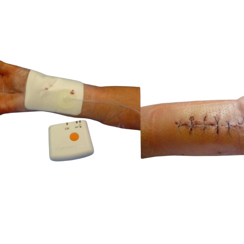 NPWT applied to a post-operative incision